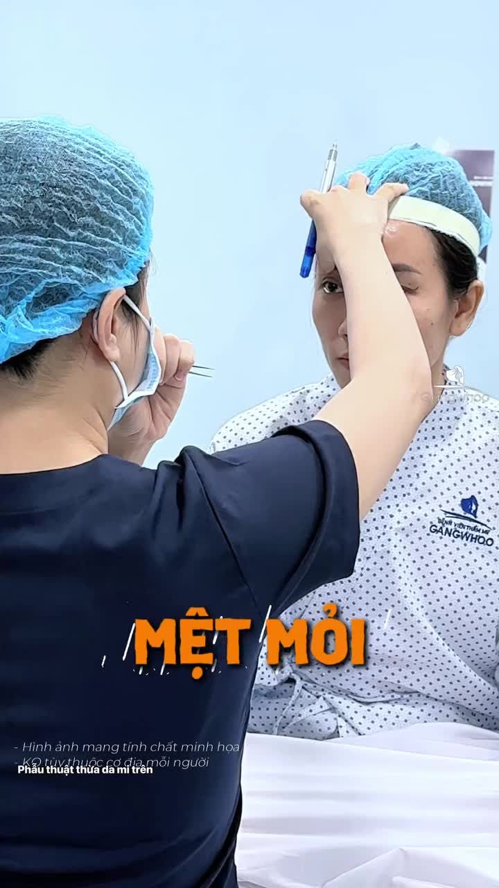 Da chùng được loại bỏ vừa đủ, bác sĩ đã định hình đường mí rõ nét. Quá trình diễn ra nhanh chóng, không gây đau và hạn chế sưng bầm tối đa