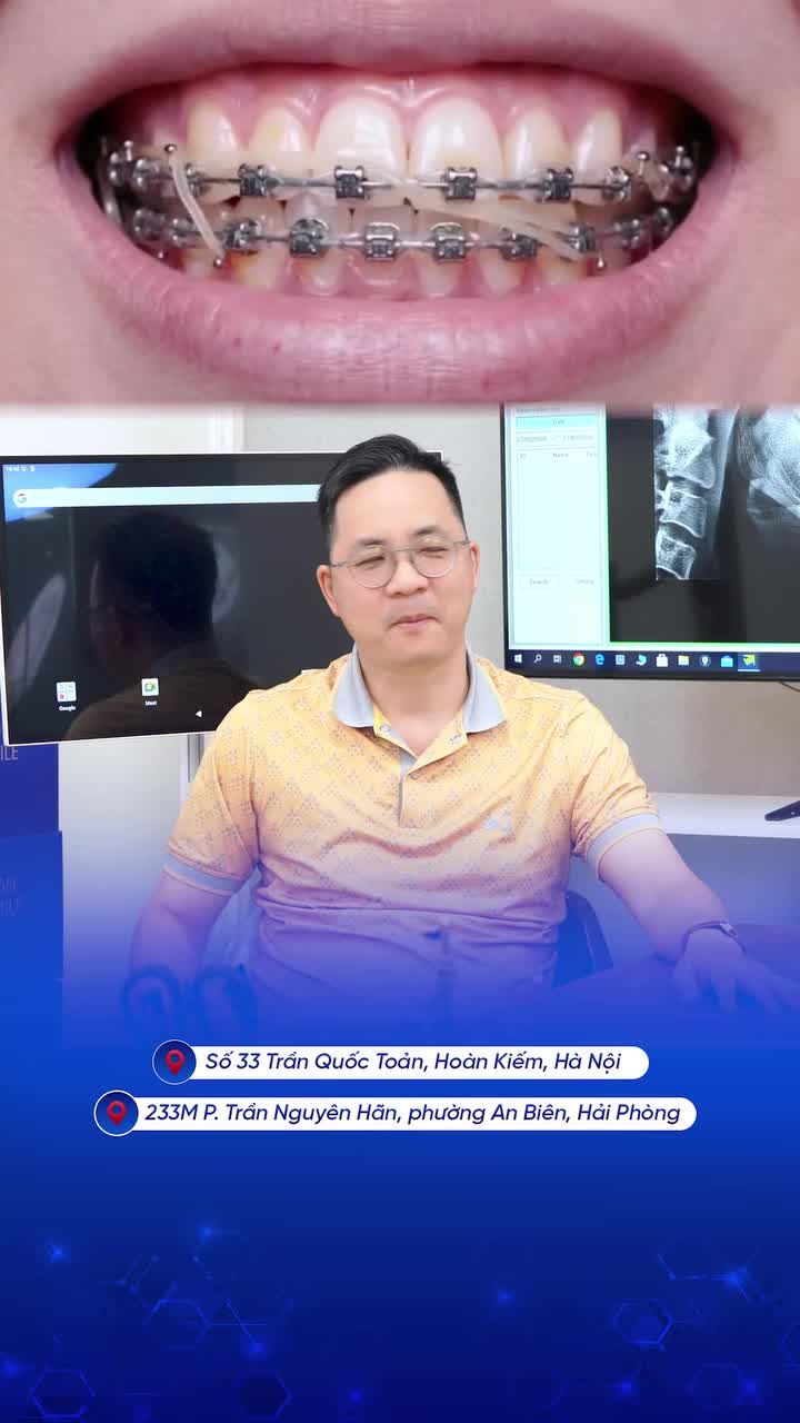 NHỔ RĂNG KHÔN ĐỂ NIỀNG RĂNG: CÓ ĐÁNG SỢ NHƯ LỜI ĐỒN?