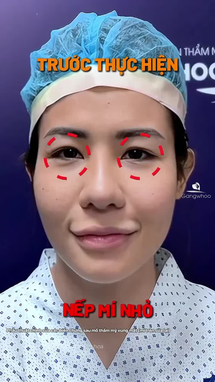 Chị khách mong muốn size mí to và đây là kết quả sau 45 phút. Kết quả hài hòa nhưng vẫn giữ được sự tự nhiên.