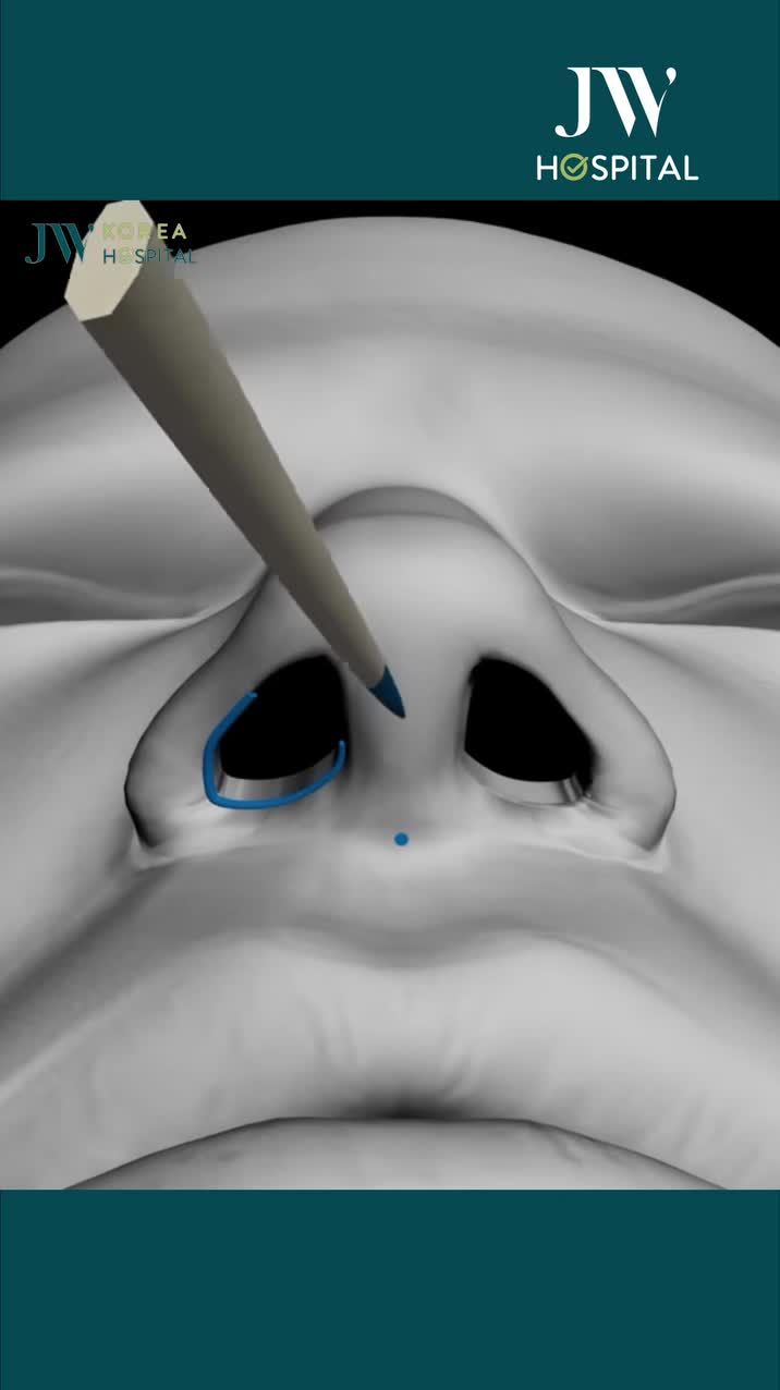 XEM NGAY QUY TRÌNH THU GỌN CÁNH MŨI AN TOÀN CHUẨN Y KHOA TẠI JW