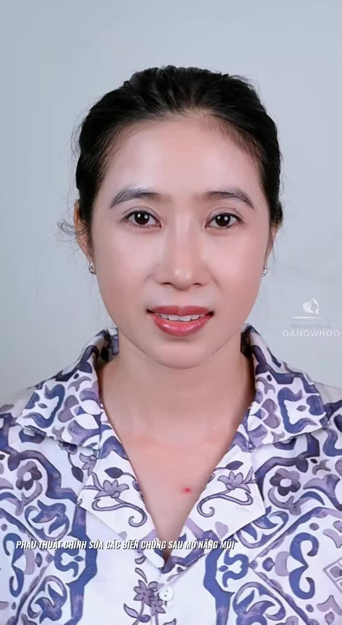 Giải cứu thành công ca mũi hỏng lệch và lộ sống