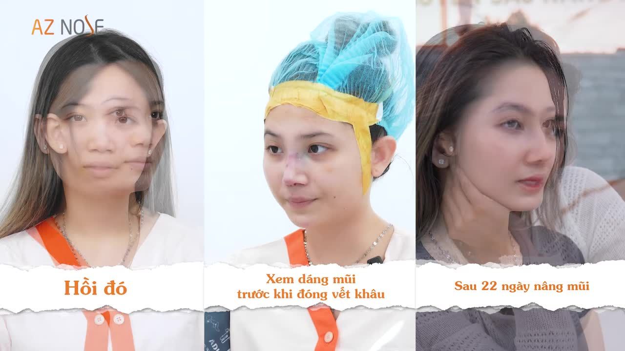 Việt kiều Mỹ thăng hạng nhan sắc với dáng mũi mới