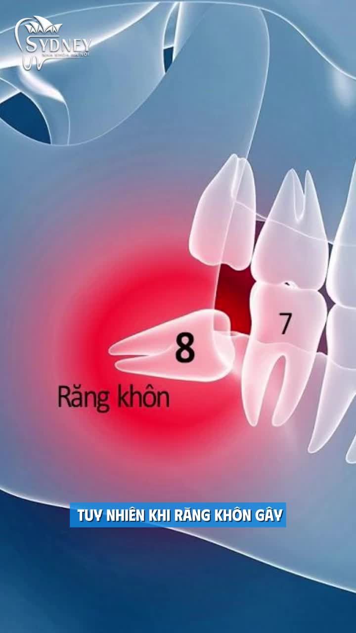 3 Trường hợp bắt buộc phải nhổ răng khôn