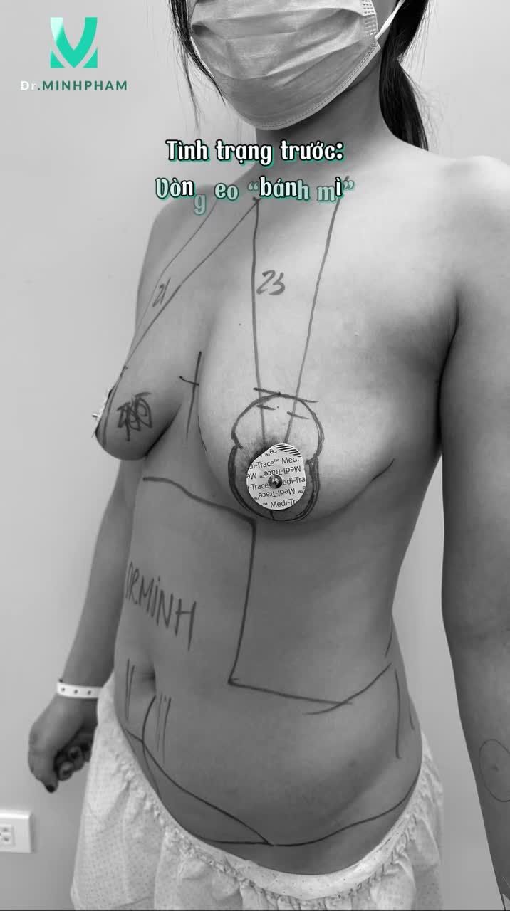 TÁI TẠO VÓC DÁNG SAU SINH LẤY LẠI ĐƯỜNG CONG TỰ TIN