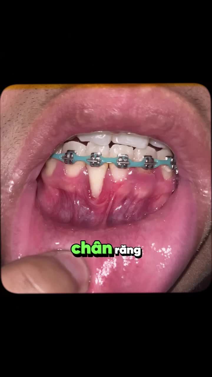 BẬT CHÂN RĂNG KHI NIỀNG CÓ SAO KHÔNG?
