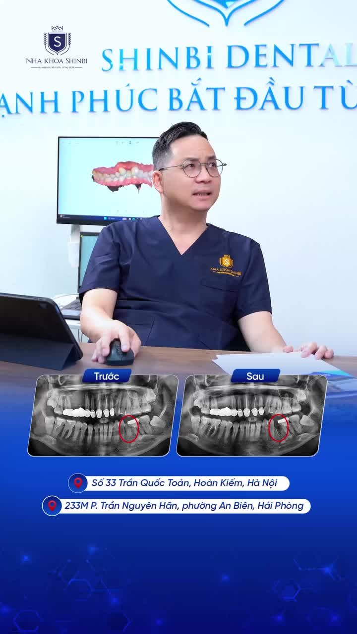 22 TUỔI ĐÃ PHẢI TRỒNG IMPLANT CHỈ VÌ THÓI QUEN NÀY