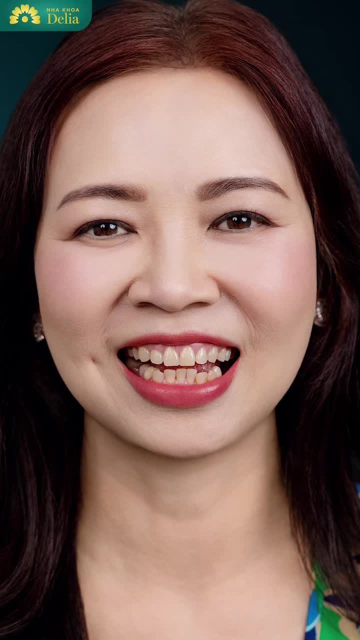 Từ Úc về Việt Nam thẩm mỹ răng sứ để thỏa mong muốn có bộ răng đẹp như bạn bè
