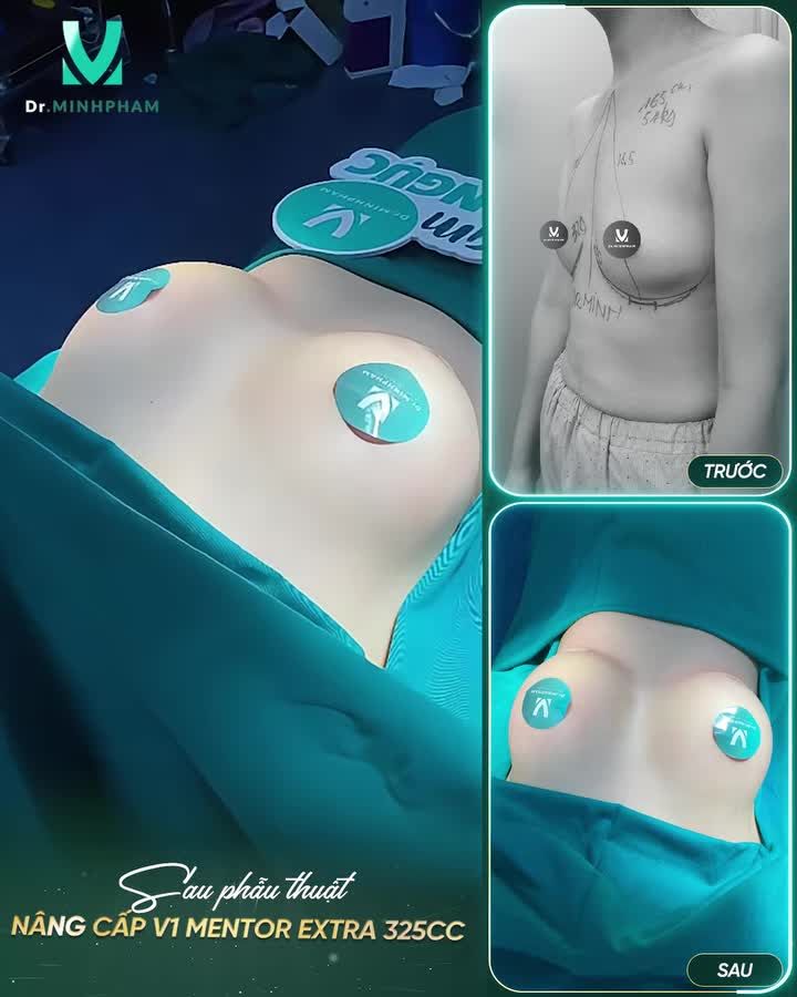 Kết quả sau khi nâng cấp V1 với dòng túi Mentor Extra 325cc tại Dr. Minh Phạm sẽ trông như thế nào ?