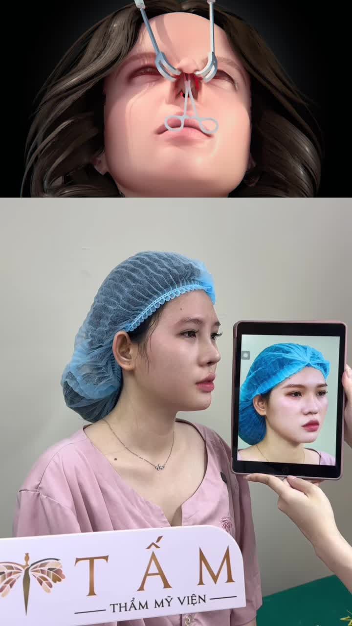 Đầu mũi to bè, sống mũi thấp làm cho bạn mất tự tin. Cùng xem trực tiếp ca biến hình sau 45 phút tại TMV Tấm.