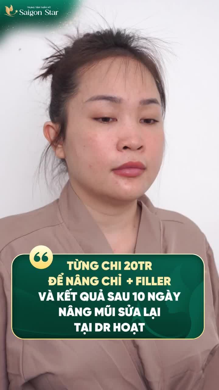 TỪNG CHI 20 TRIỂ ĐỂ NÂNG MŨI CHỈ VÀ TIÊM FILLER MŨI - CHỊ KHÁCH PHẢI ĐẾN BÁC SĨ HOẠT ĐỂ TÌM LẠI DÁNG MŨI ĐẸP BỀN VỮNG!!!