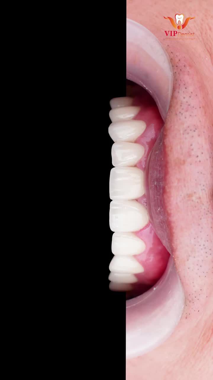 HỒI SINH NỤ CƯỜI – TRẺ LẠI 10 TUỔI CÙNG NHA KHOA QUỐC TẾ VIP DENTIST