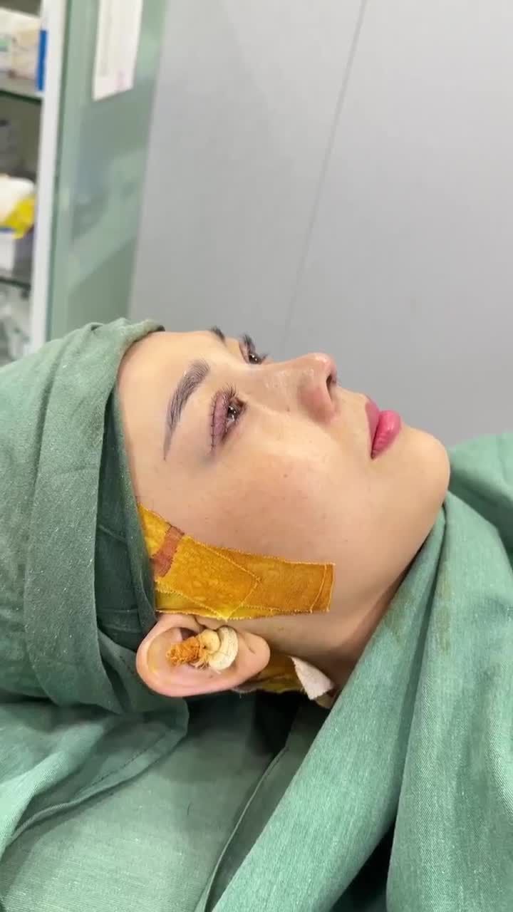 KẾT QUẢ CẮT COMBO MẮT 2 MÍ + NÂNG MŨI CẤU TRÚC DR. HOẠT