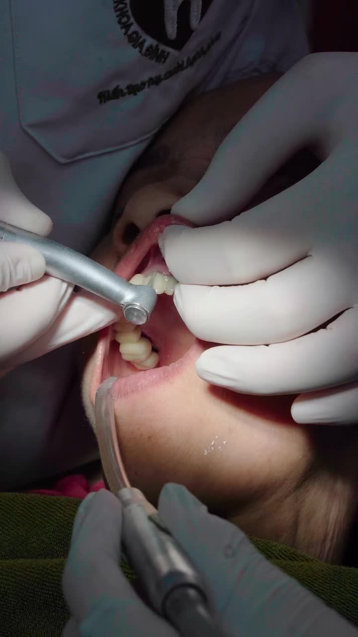 CẮT CẦU SỨ DÀI LÂU NĂM ĐỂ CẤY GHÉP IMPLANT