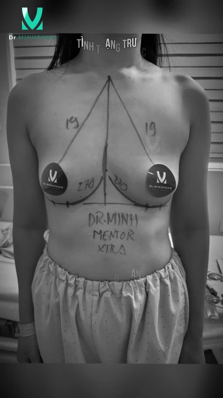 Vòng 1 chảy xệ, kém săn chắc ▸ thử ngay là dòng túi Mentor extra tại Dr. Minh Phạm