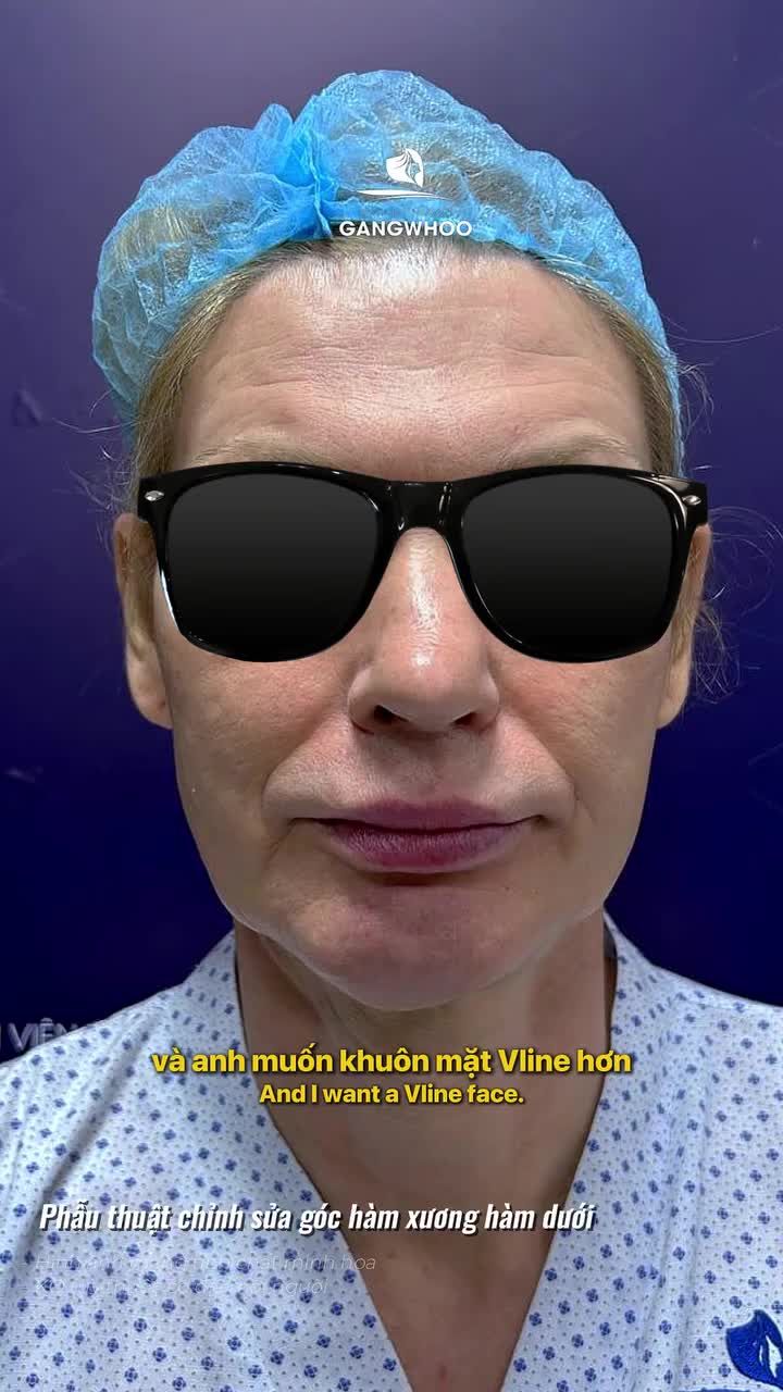 Bác sĩ phân tích ca gọt hàm đặc biệt của khách hàng đến từ Nga. Cùng theo dõi và đón chờ kết quả ngoạn mục từ khách hàng này nhé.