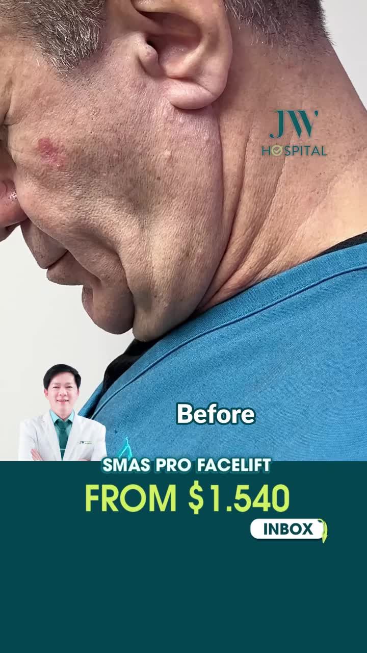 TIẾT KIỆM ĐẾN 10 LẦN CHO SMAS PRO FACELIFT TẠI VIỆT NAM – CHẤT LƯỢNG CÙNG, LỰA CHỌN THÔNG MINH HƠN