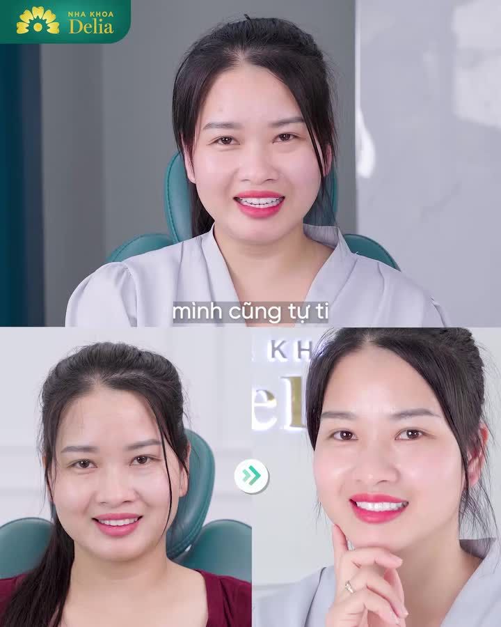 Chủ Đại lý vật tư nông nghiệp đi làm 17 răng sứ HT Smile … chính vì câu nói: “Ăn đu đủ không cần thìa!”
