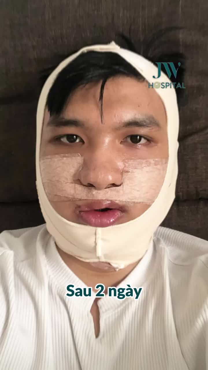 PHẪU THUẬT HÀM MÓM LÀM 1 LẦN ĐẸP 1 ĐỜI! NAM SINH GEN Z ĐỔI ĐỜI THÀNH SOÁI CA