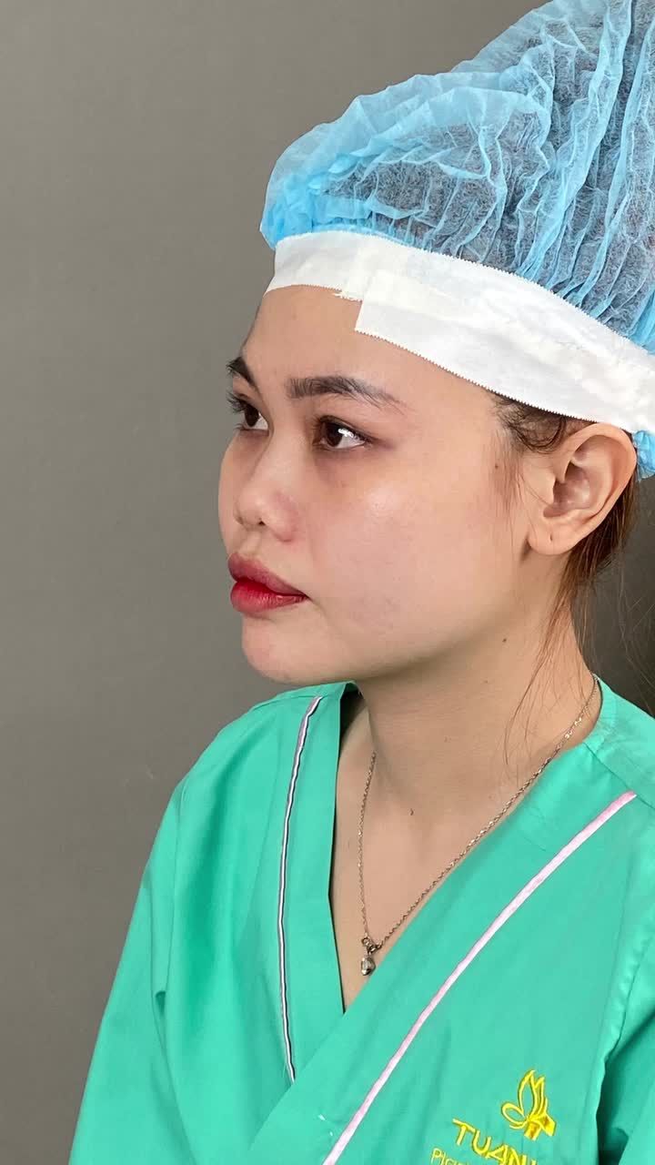 SAU KHI TIÊM TAN FILLER NÂNG MŨI BỊ BẦM– CÓ ĐÁNG LO?!!