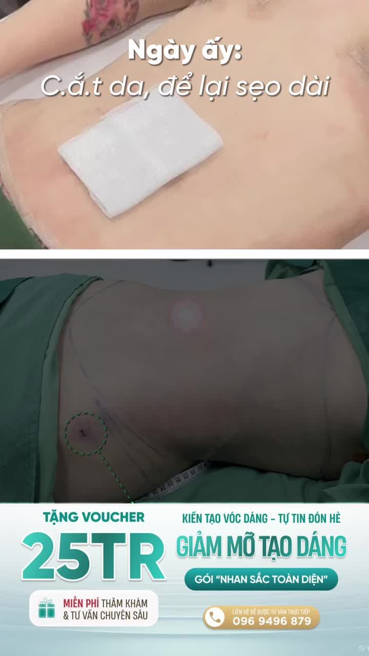 "Muốn bụng phẳng lỳ là phải chấp nhận phẫu thuật cắt da, đánh đổi vóc dáng lấy vết sẹo dài hằn sâu suốt đời" – Sự thật là gì?