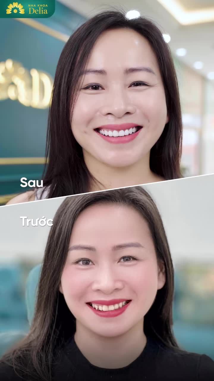 “Ai cũng khen trẻ ra và xinh hơn nhưng không biết là do làm răng sứ”