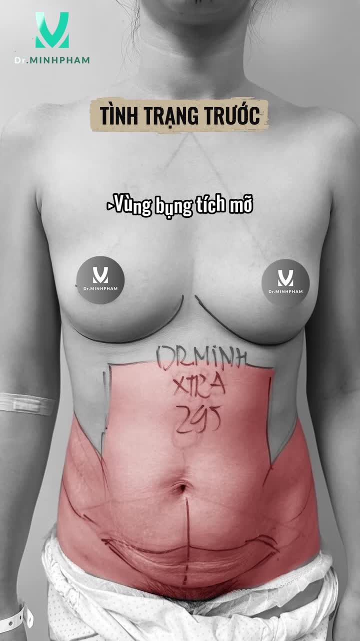 Kết quả sau phẫu thuật tại Dr. Minh Phạm với combo hút mỡ THTB bán phần kết hợp nâng ngực Mentor Extra 295cc