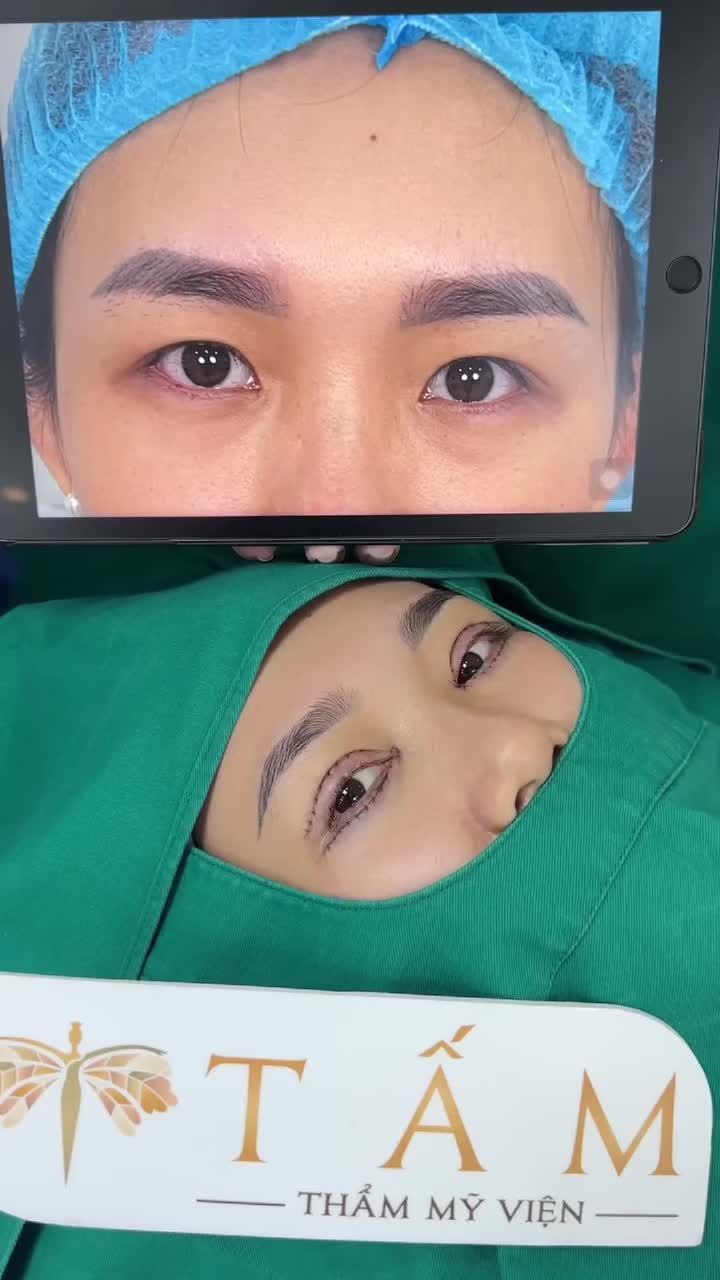 Hình ảnh khách hàng vừa làm xong combo mí trên + mí dưới + bóc mỡ