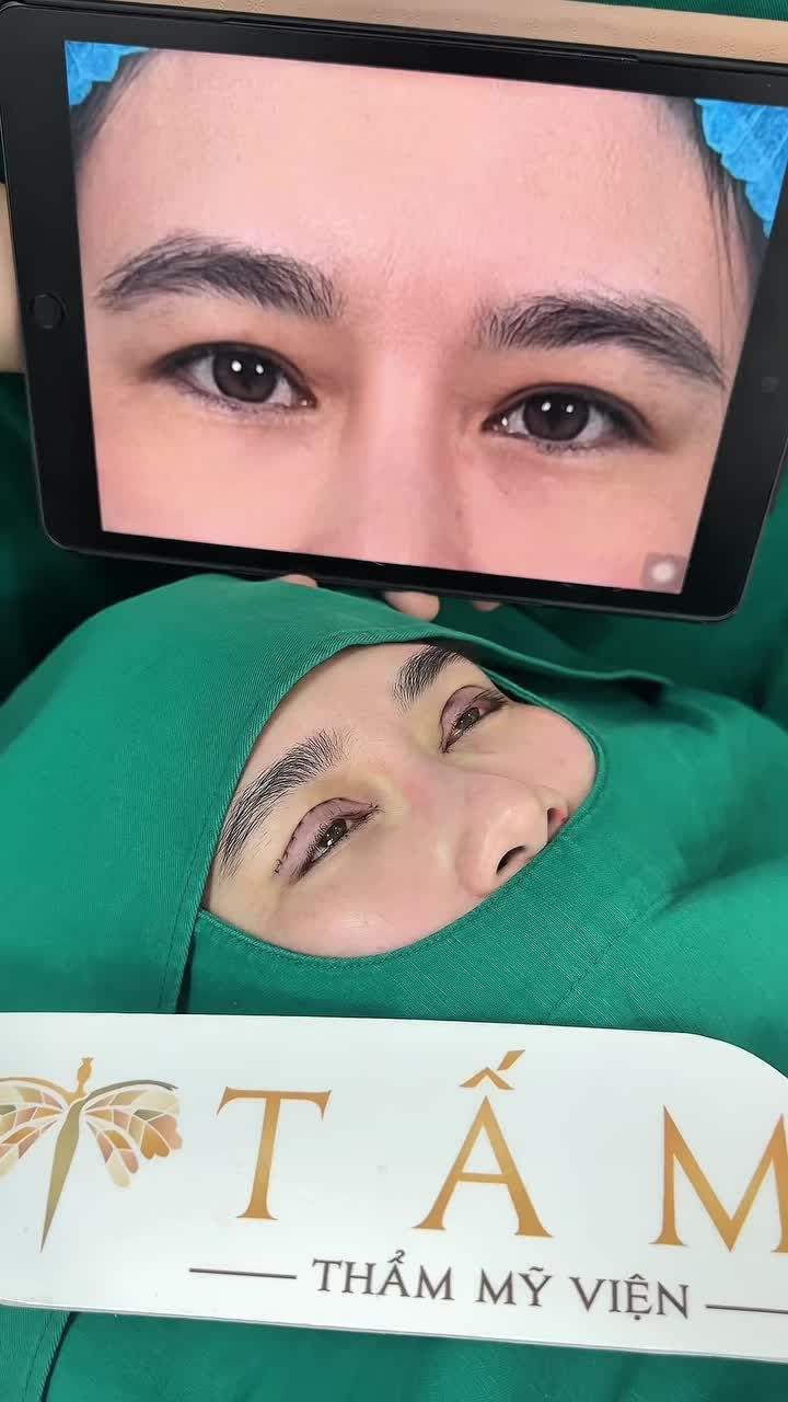 Cùng nghe chia sẻ sau khi làm combo cắt mí trên kết hợp mở góc mắt trong của chị KH nhé