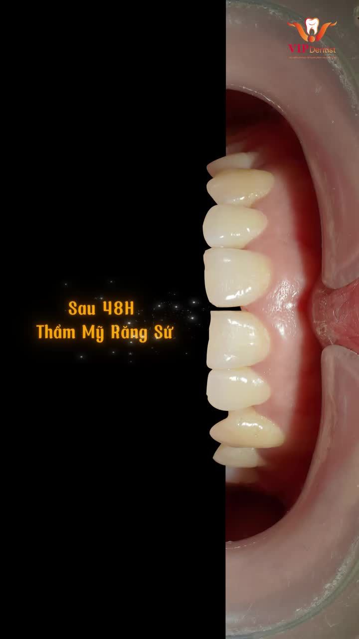 CHỈ 48H CÓ NGAY NỤ CƯỜI MỚI TẠI VIP DENTIST!