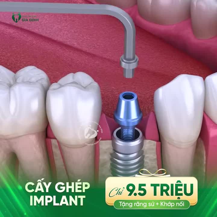 TRỒNG RĂNG IMPLANT - GIẢI PHÁP ĂN NHAI LÂU DÀI, TỐI ƯU CHI PHÍ