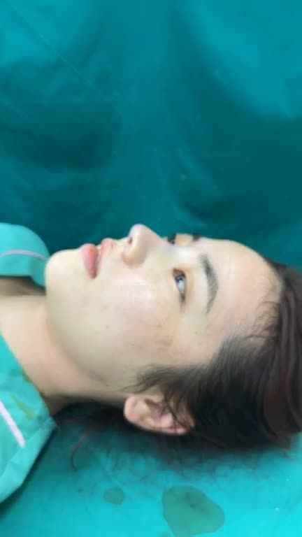 NÂNG MŨI CẤU TRÚC VỪA HOÀN THÀNH!!!