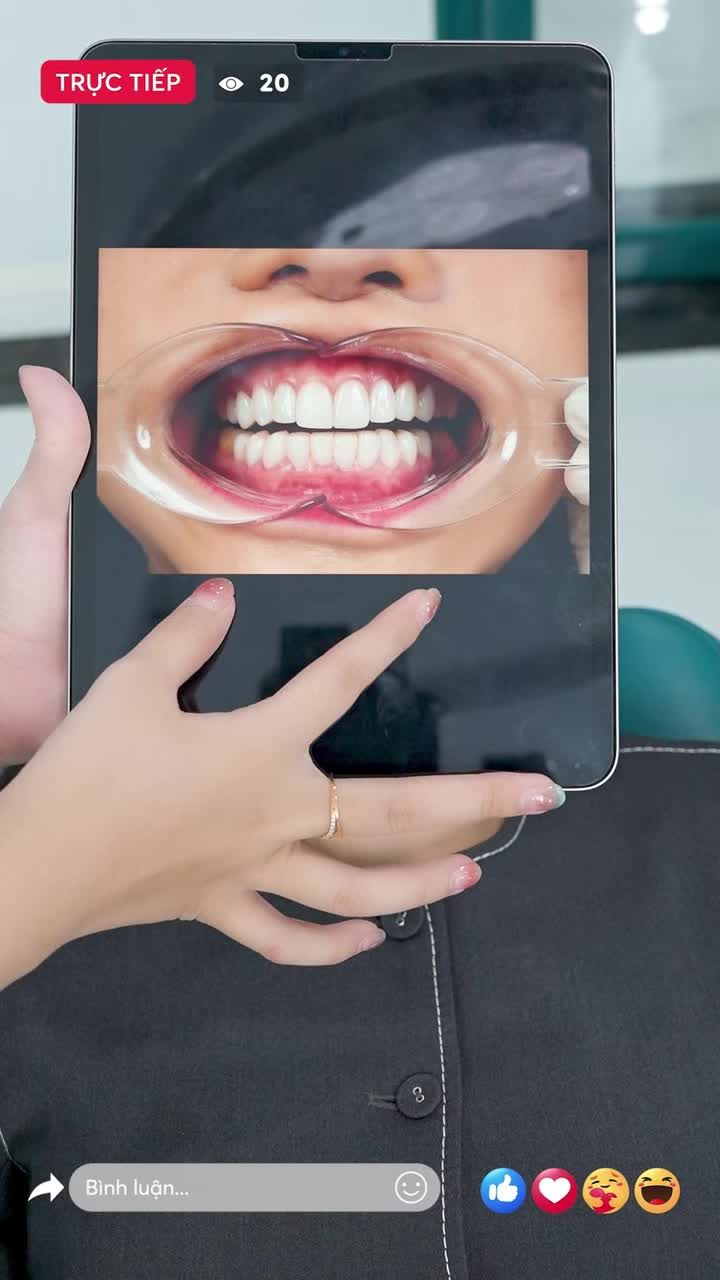 Cận cảnh dáng răng thỏ vừa hoàn thiện tại Delia.