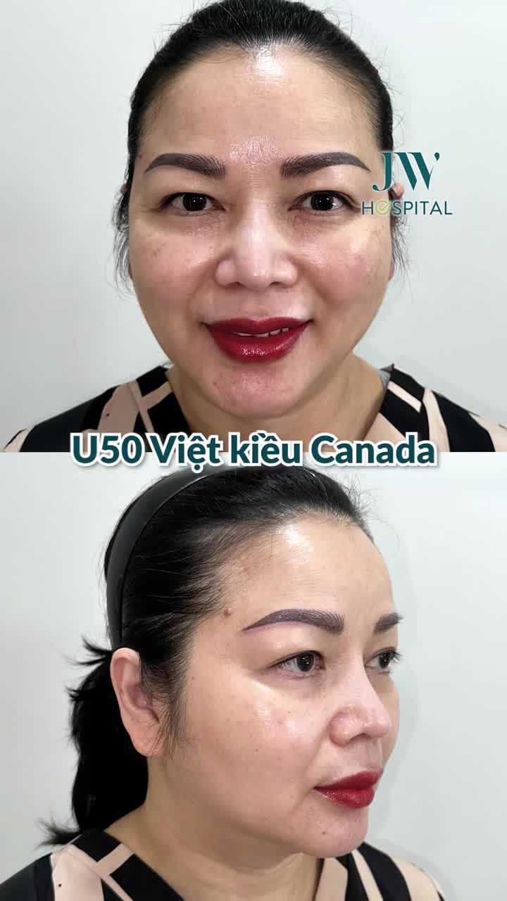 BÁC SĨ TÚ DUNG CĂNG CHỈ MESH LIFT KHÔNG SẸO GIÚP NỮ VIỆT KIỀU U50 CẢI LÃO 20 TUỔI