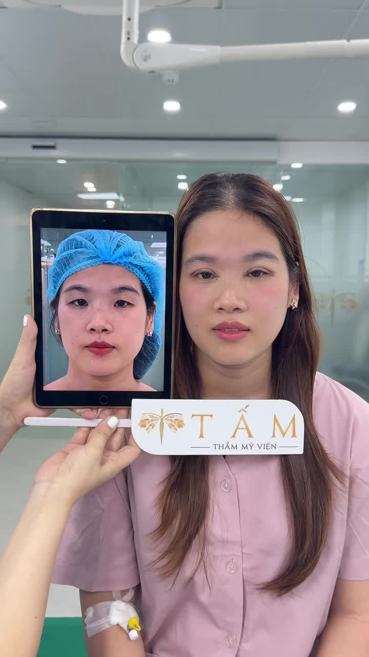 45 phút thay đổi diện mạo, đôi mắt một mí cụp buồn nay đã trở nên to tròn, rõ nếp nhờ Combo Cắt mí và Mở góc mắt tại TMV Tấm. Kết quả không chỉ là vẻ đẹp bề ngoài mà còn là sự tự tin mới, rạng ngời.