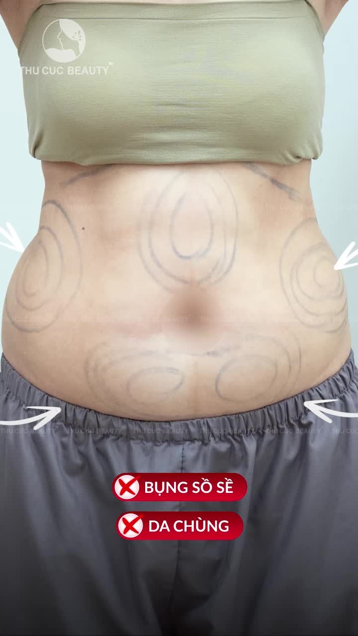 Hút mỡ Vaser Lipo - Định hình vóc dáng độ nét cao