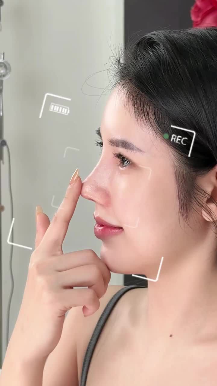 NÂNG MŨI CẤU TRÚC SỬA LẠI – KẾT QUẢ ĐẸP “CHẤN ĐỘNG”!!