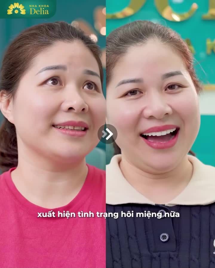 U41 ở Đội Cấn chọn thẩm mỹ 20 răng sứ Lava Plus trước thềm chuyến du lịch cùng nhóm bạn thân