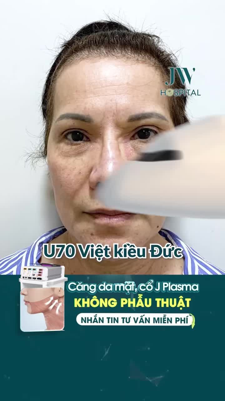 BÁC SĨ TÚ DUNG NÓI GÌ VỀ SIÊU CÔNG NGHỆ CĂNG DA MẶT CỔ KHÔNG PHẪU THUẬT ĐANG GÂY BÃO TẠI JW?