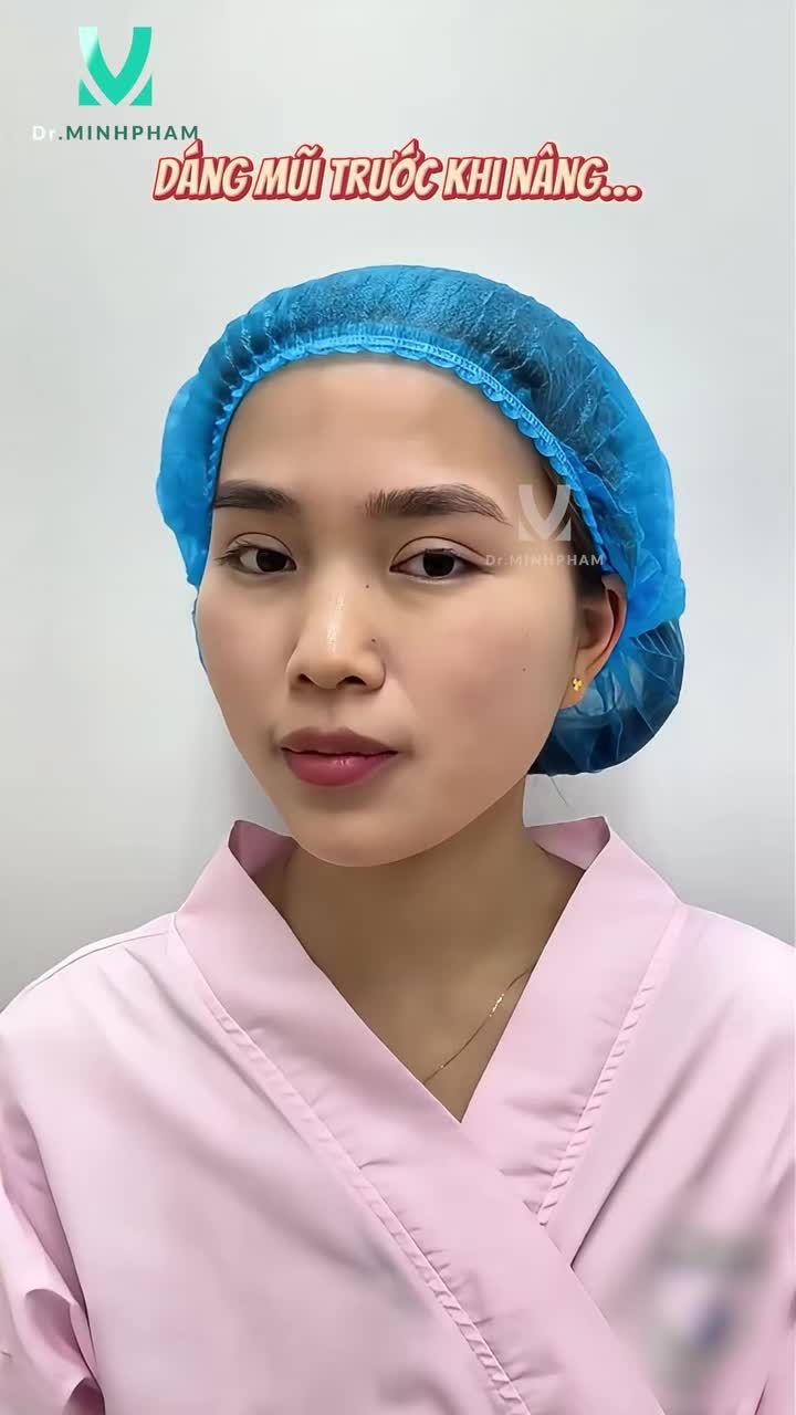 Ngày trước, chị Nguyệt luôn tự ti vì dáng mũi thấp, đầu mũi to