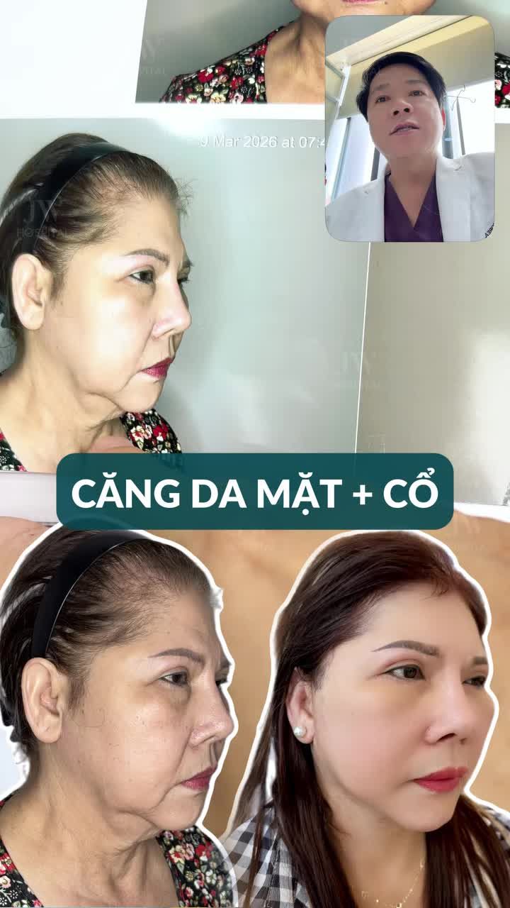 BÁC SĨ TÚ DUNG CĂNG DA MẶT SMAS PRO GIÚP NỮ VIỆT KIỀU MỸ U70 XÓA NHĂN HẾT NỌNG TRẺ NHƯ GÁI 18