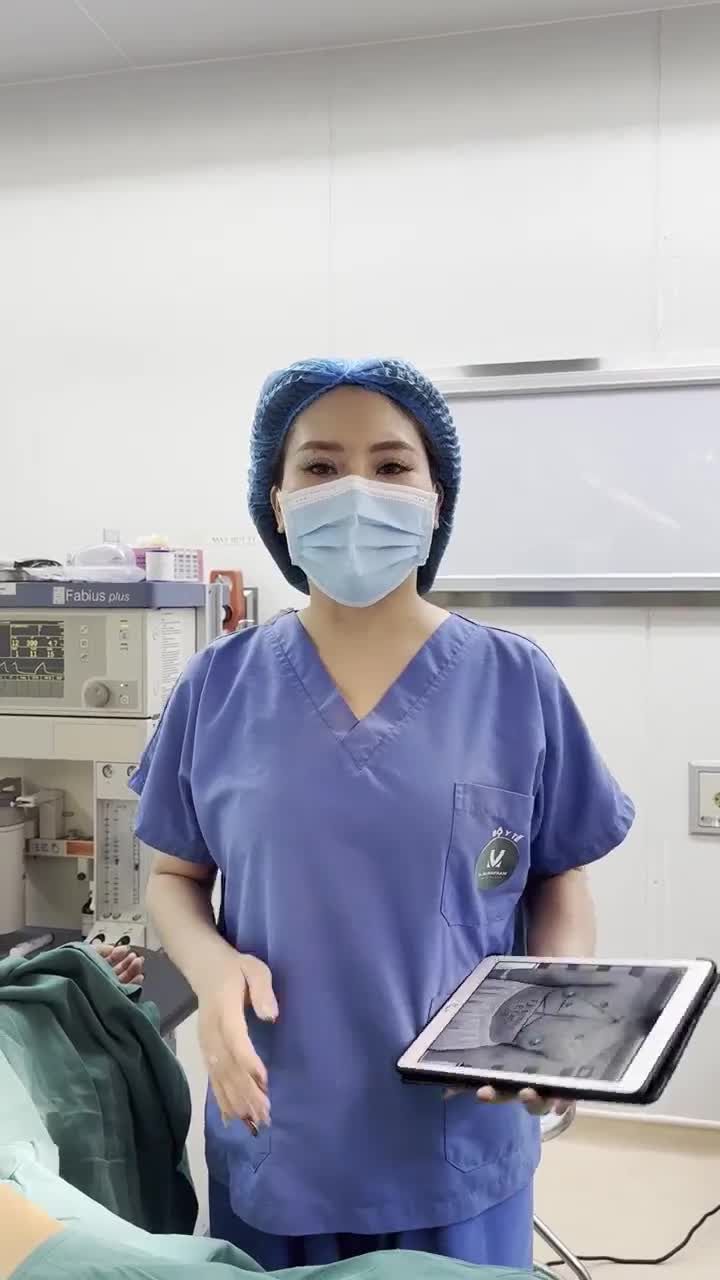 Ca nâng cấp V1 size 315cc