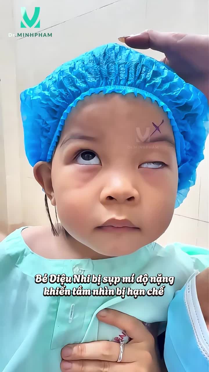 Cùng chiêm ngưỡng kết quả sau phẫu thuật sụp mi của bé Diệu Nhi