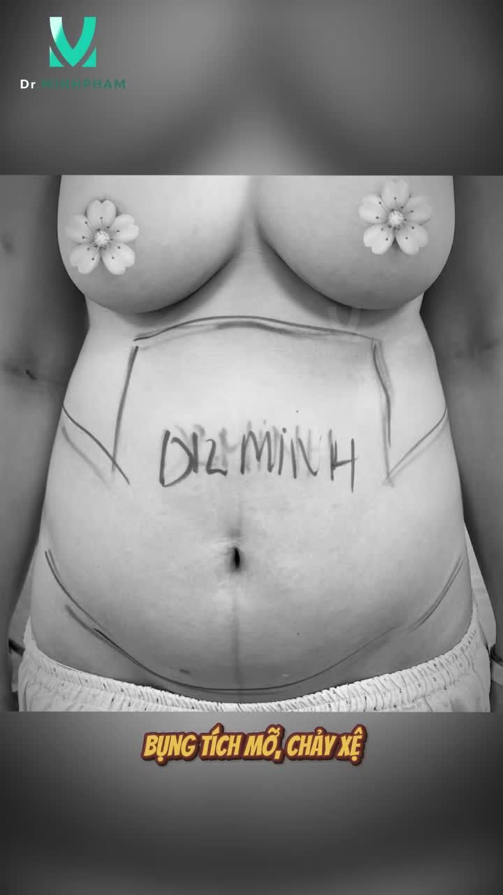 Với trường hợp mỡ dày tích tụ nhiều Ts.Bs. Phạm Ngọc Minh đã thực hiện combo tái tạo vóc dáng toàn diện