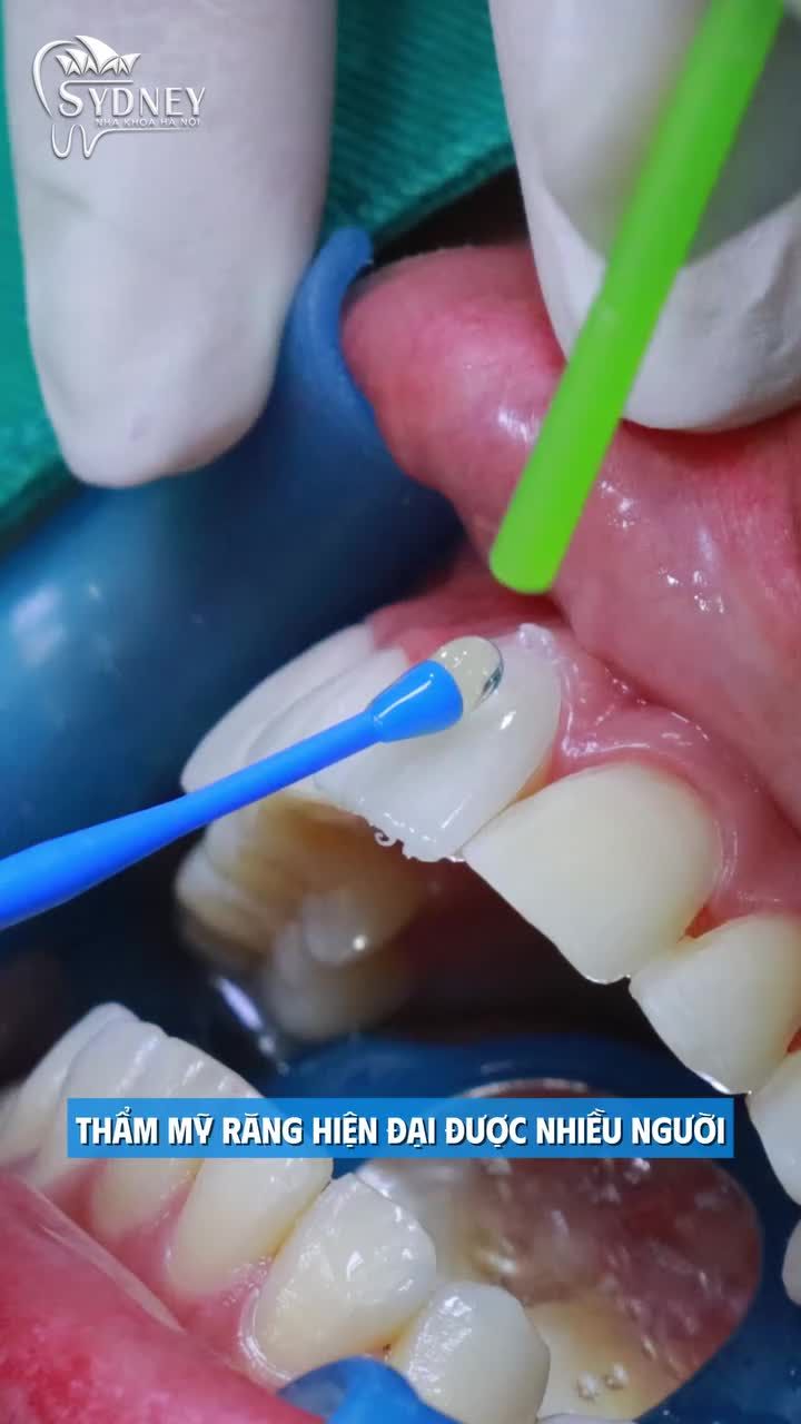 Dán sứ Veneer có thể sử dụng trong bao lâu?