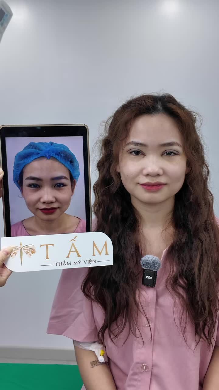 Phỏng vấn khách hàng làm Combo "Cắt mí Shanghai + mở góc trong"