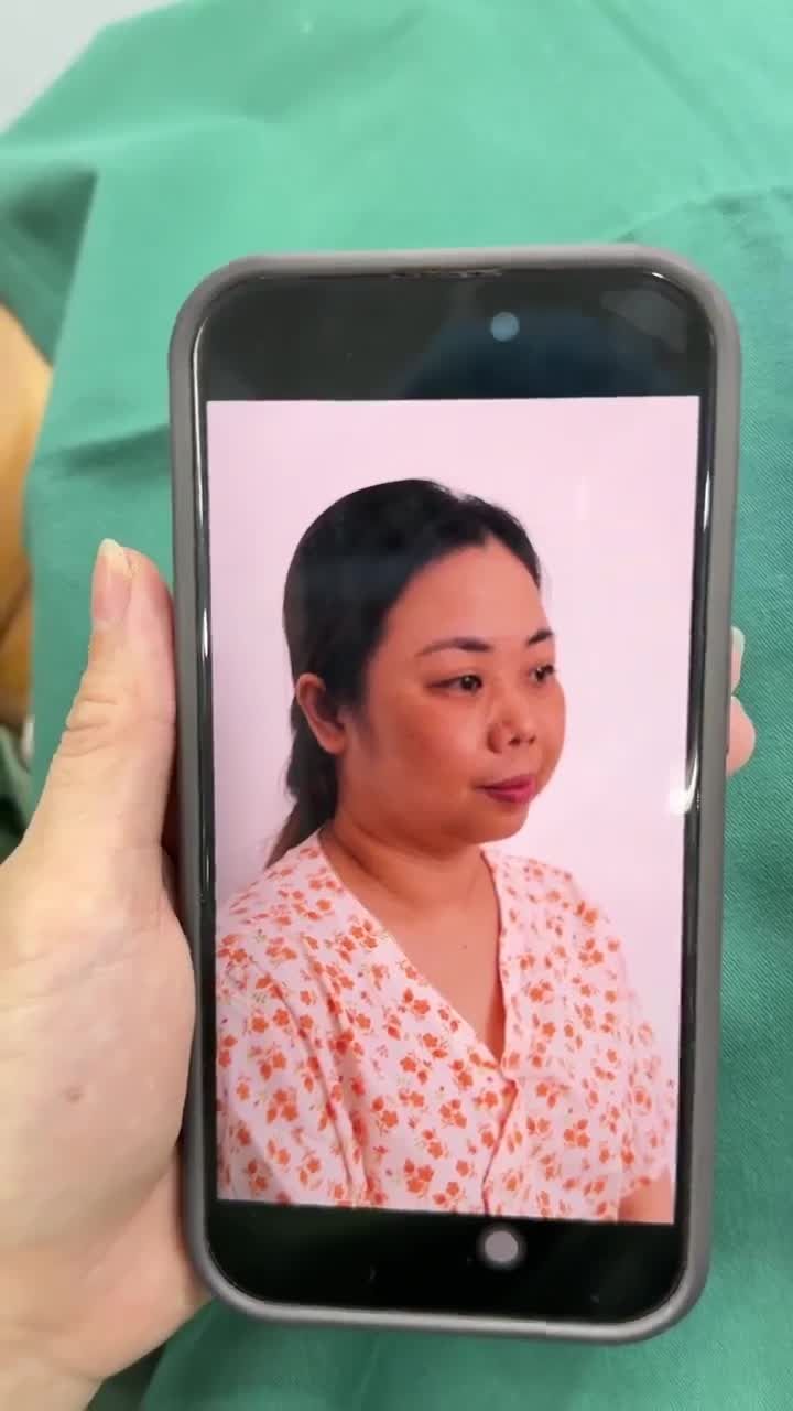 KẾT QUẢ SAU 60 PHÚT NÂNG MŨI CẤU TRÚC DR. HOẠT