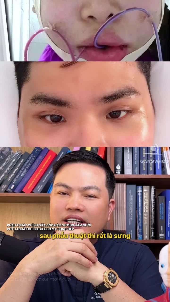 Gọt hàm/hạ gò má nội soi có ưu điểm gì so với Gọt hàm/hạ gò má thông thường?