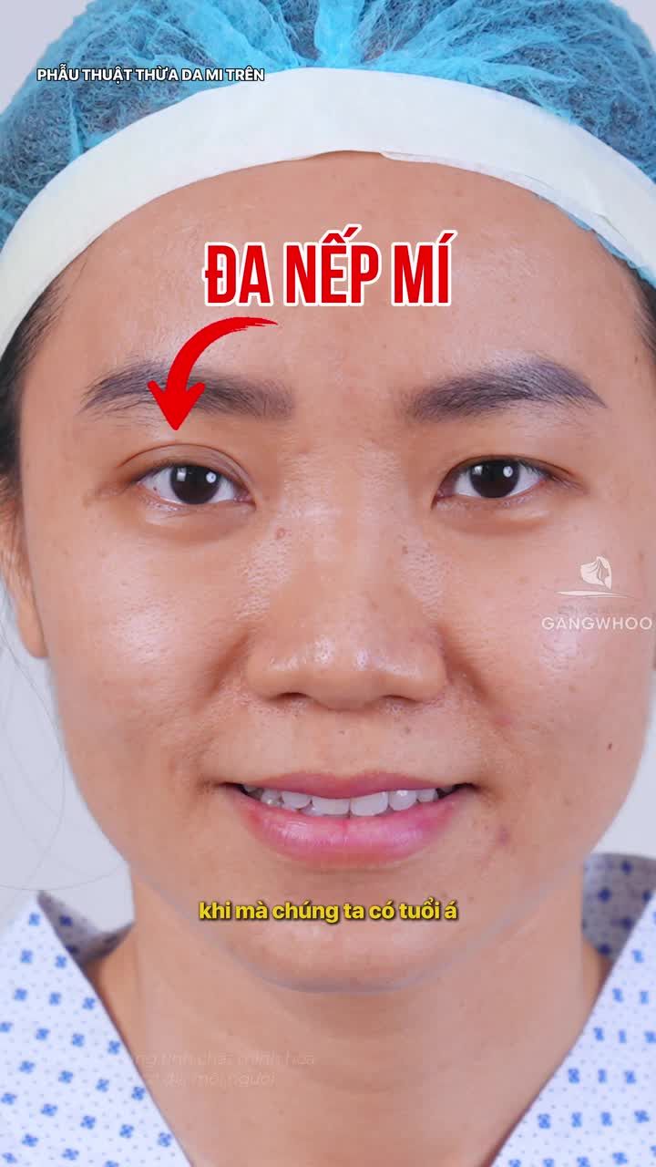 Mí mắt không đều khiến gương mặt kém hài hòa…Nhưng liệu có phải ai cũng cần can thiệp giống nhau?