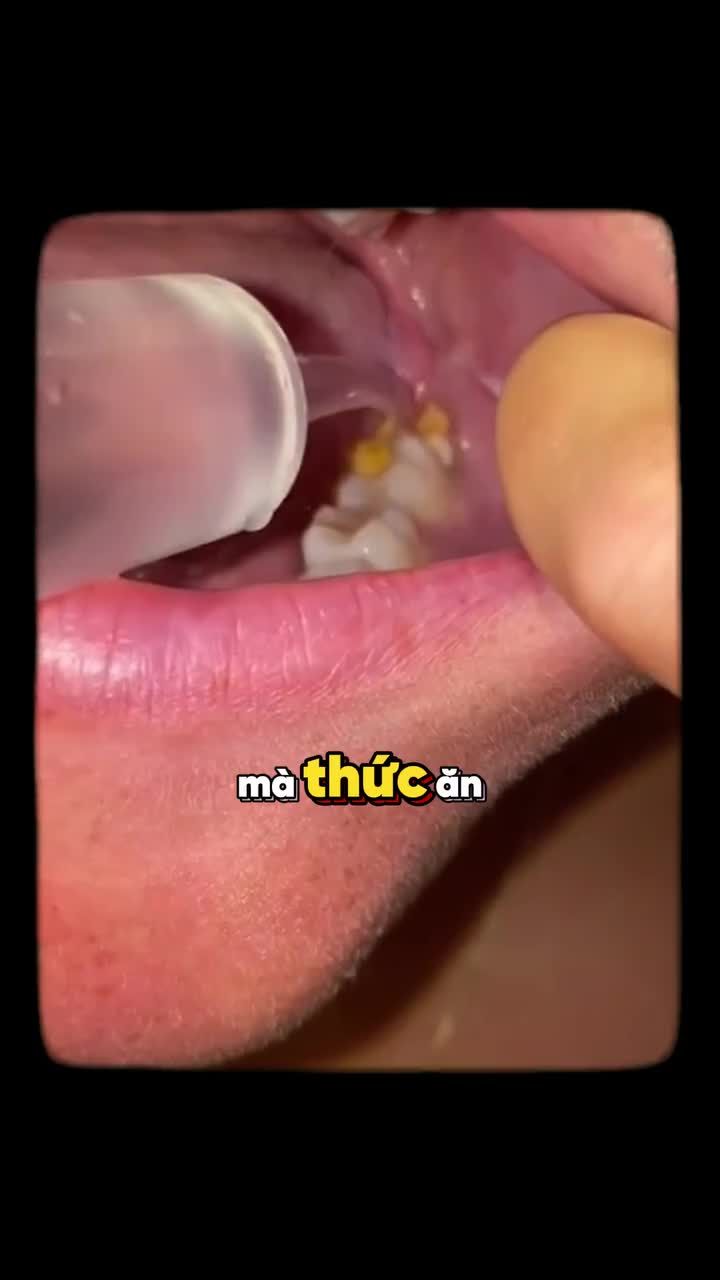 THỨC ĂN KẸT TRONG LỖ NHỔ RĂNG?