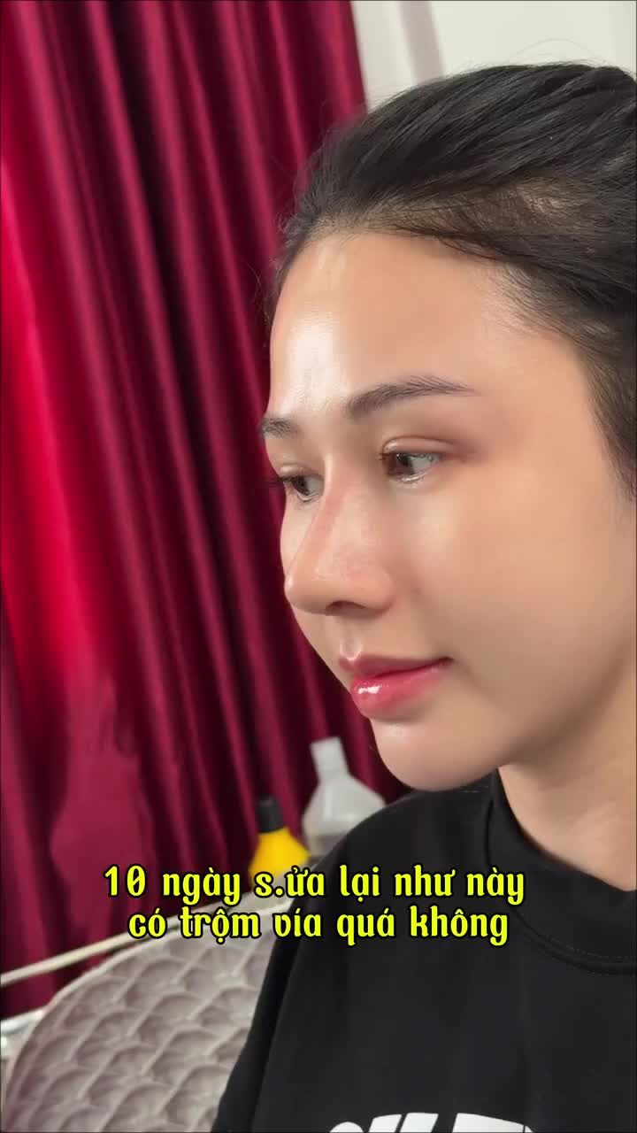 DÁNG MŨI SAU 10 NGÀY TÁI KHÁM – FORM ĐÃ RÕ, XINH THẤY LIỀN